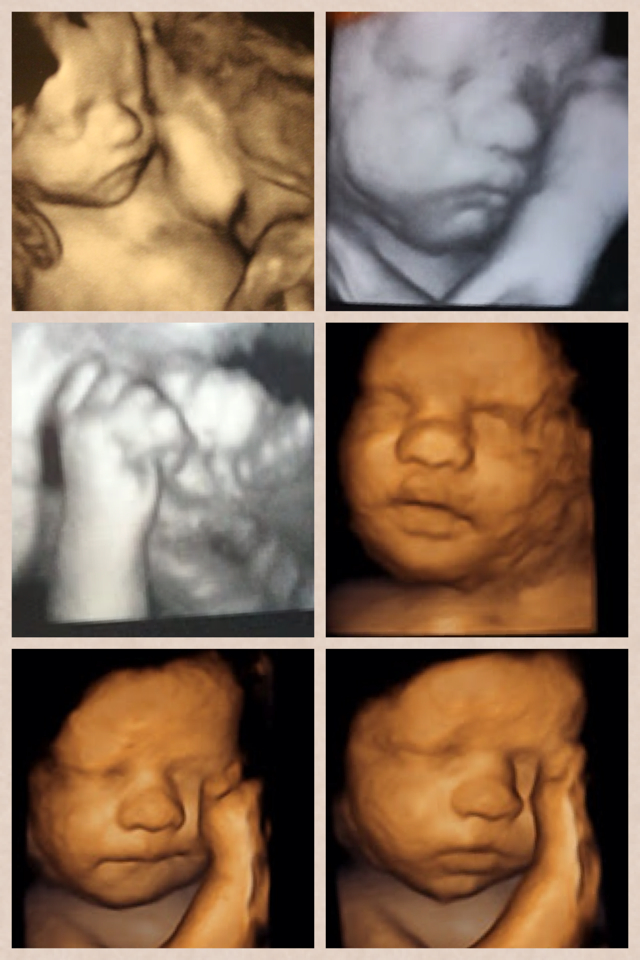 Amazing pictures of Baby Murphy. God has created a beautiful little baby for a beautiful purpose. What a sweetie!